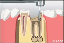 traitement radiculaire