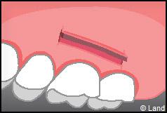 Chirurgie mucogingivale